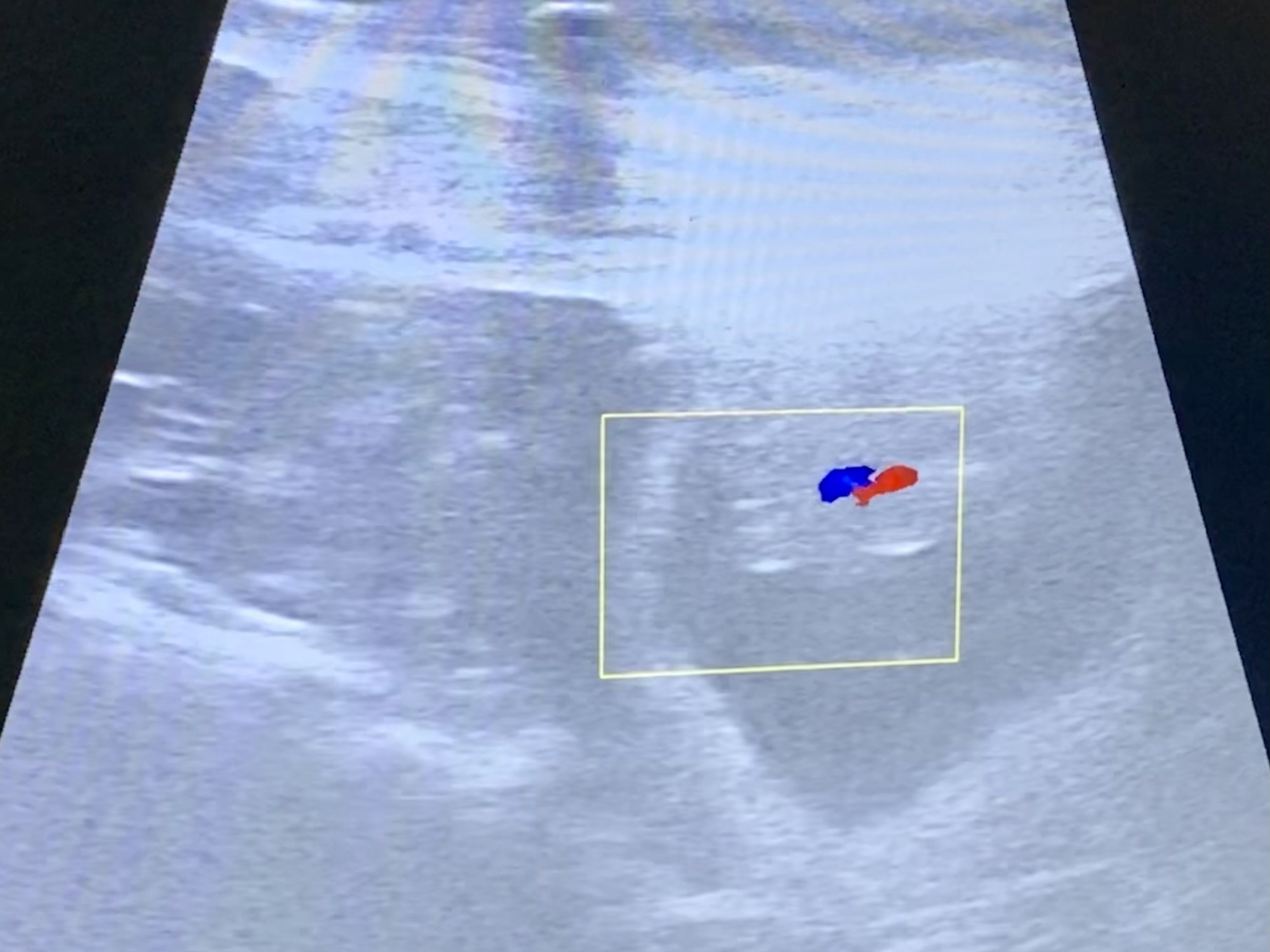 Ultraschall Ultraschall